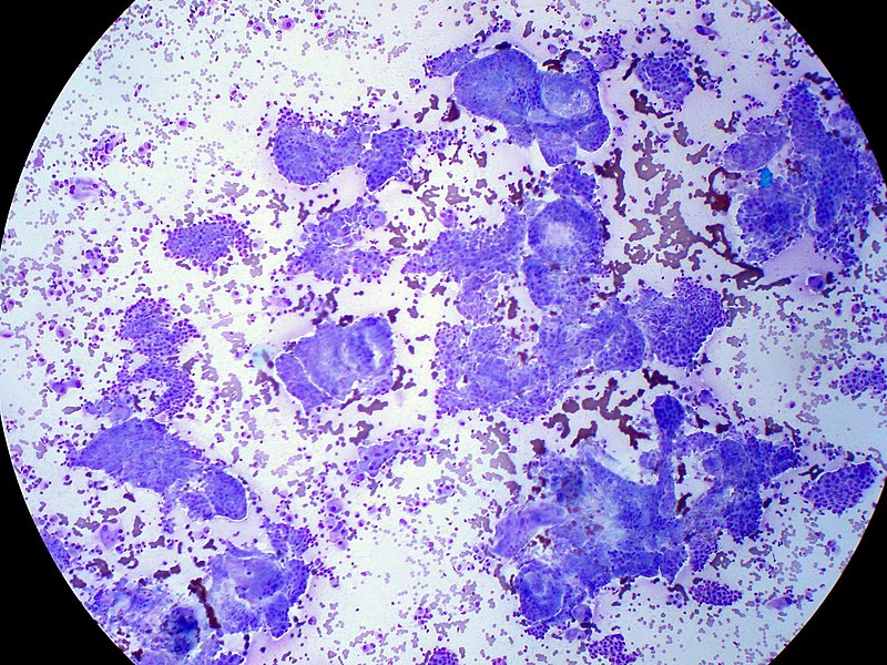 Papillary thyroid carcinoma , FNA giemsa stain
