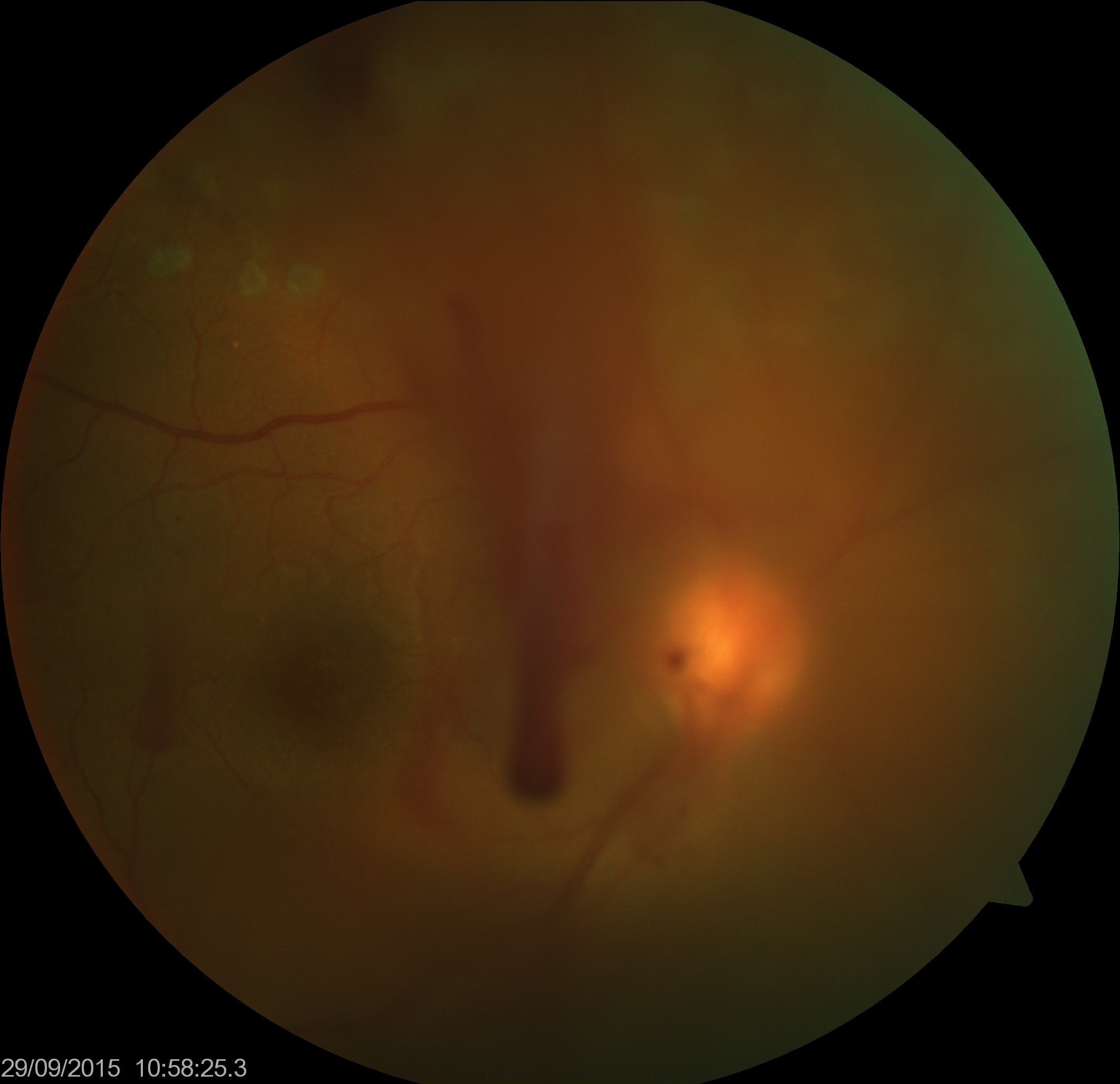 Vitreous hemorrhage in an eye with proliferative diabetic retinopathy which has already been lasered before.