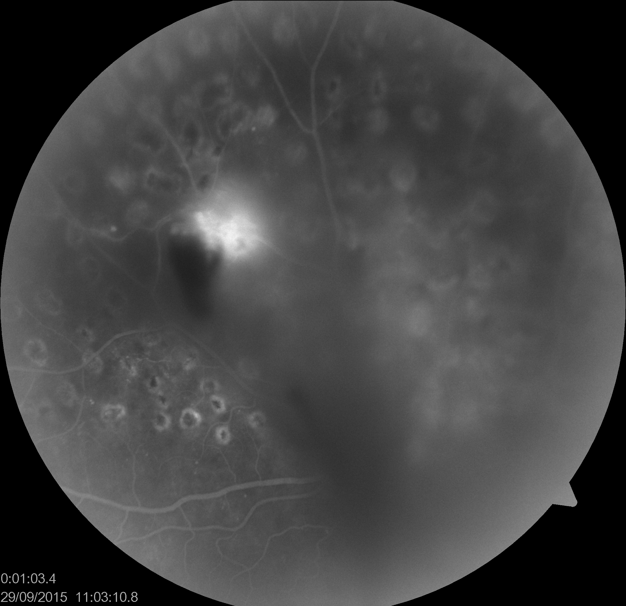 Fundus Fluorescein angiography of the same eye shows leakage from an active NVE (neovascularisation elsewhere)