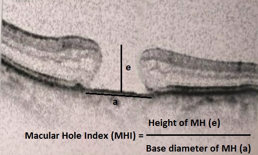 SD-OCT (macular scan) showing calculation of Macular Hole Index (MHI)