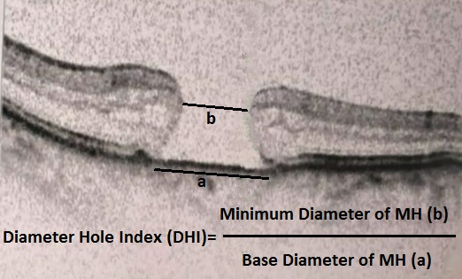 SD-OCT (macular scan) showing calculation of Diameter Hole Index (DHI)