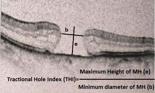 SD-OCT (macular scan) showing calculation of Tractional Hole Index (THI)