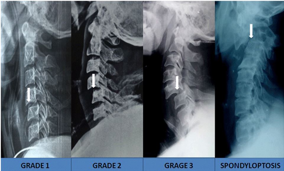 Meyerding grades of spinal subluxation