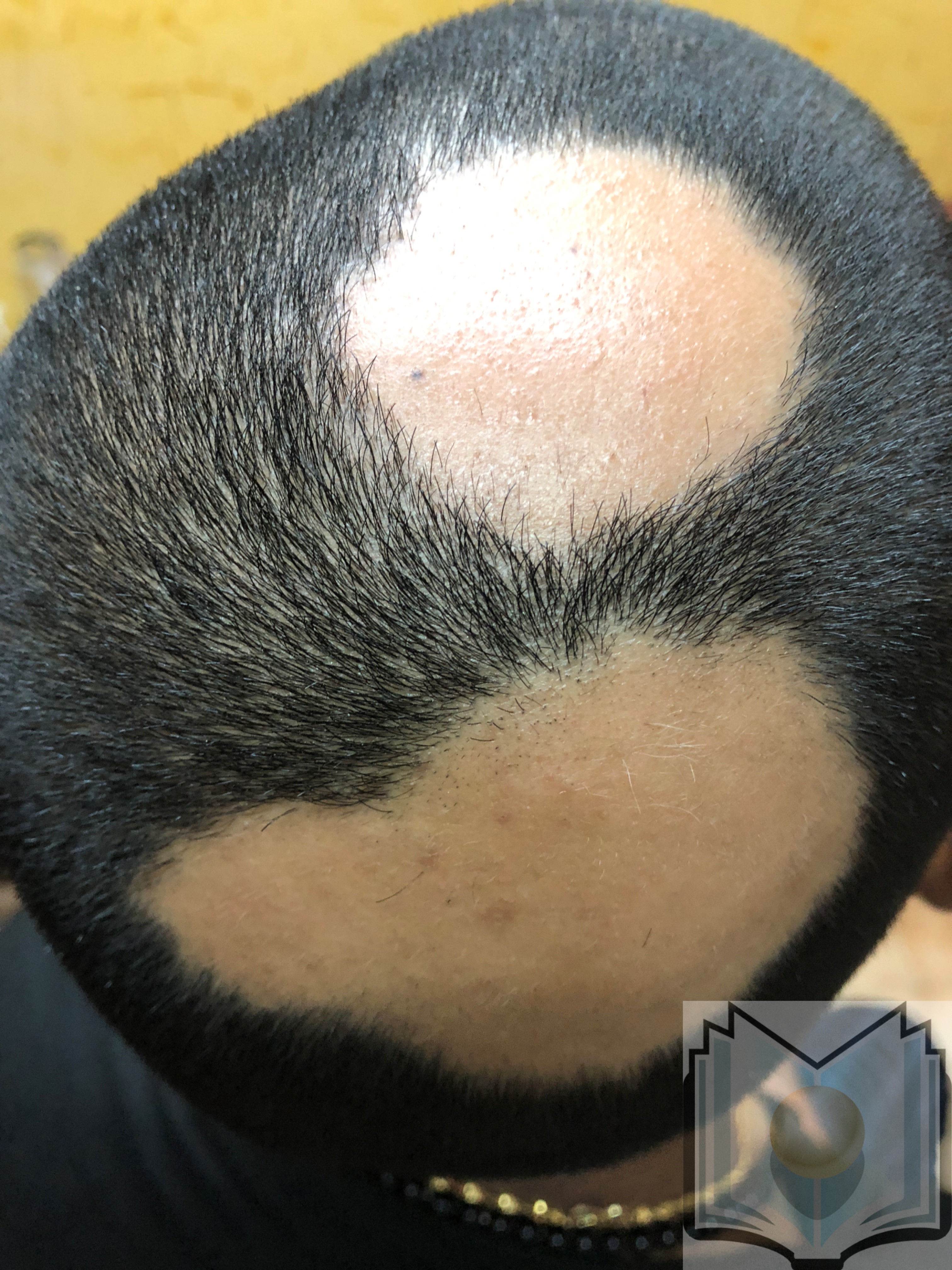 <p>Alopecia Areata