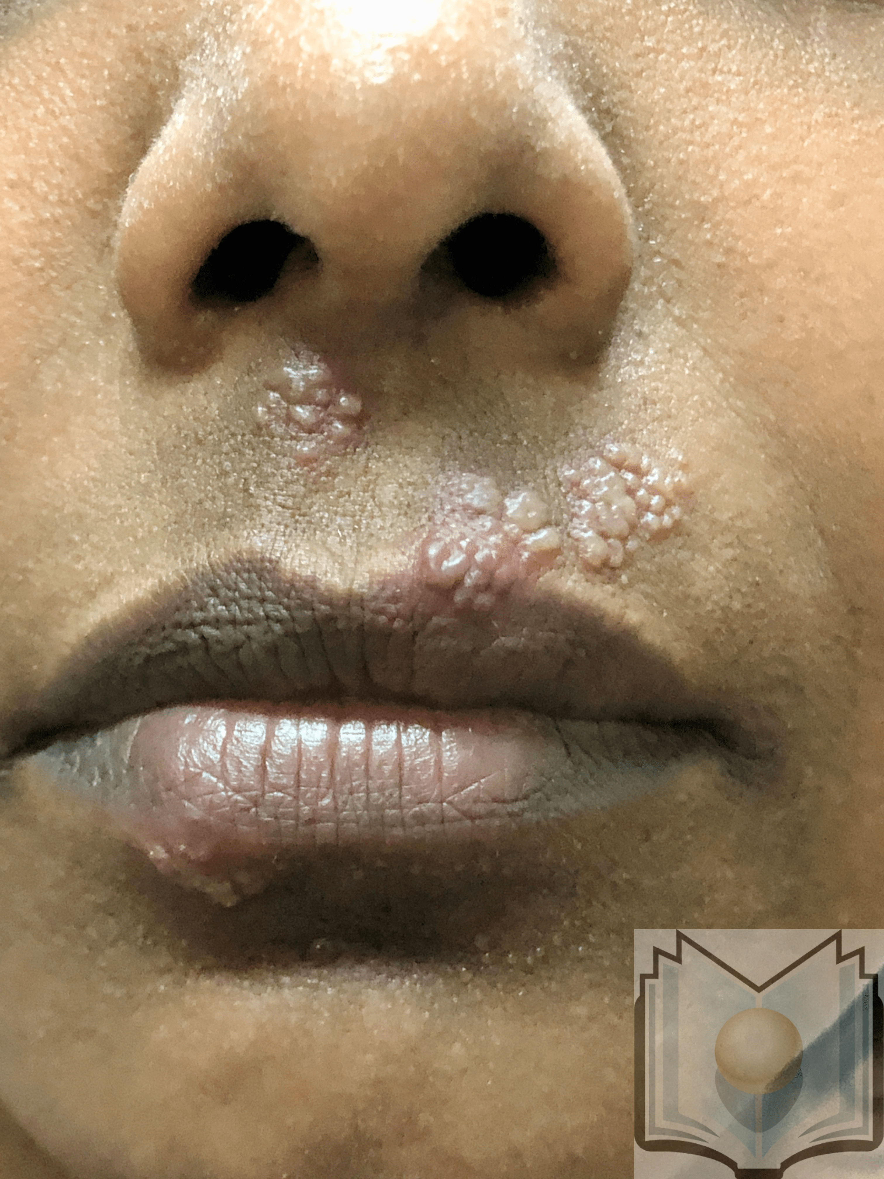 Herpes Simplex mouth