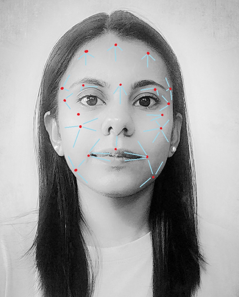 Most common injection sites and direction for fat grafting on the face. Red dots denote the injection sites and blue lines indicate the direction of the injected fat