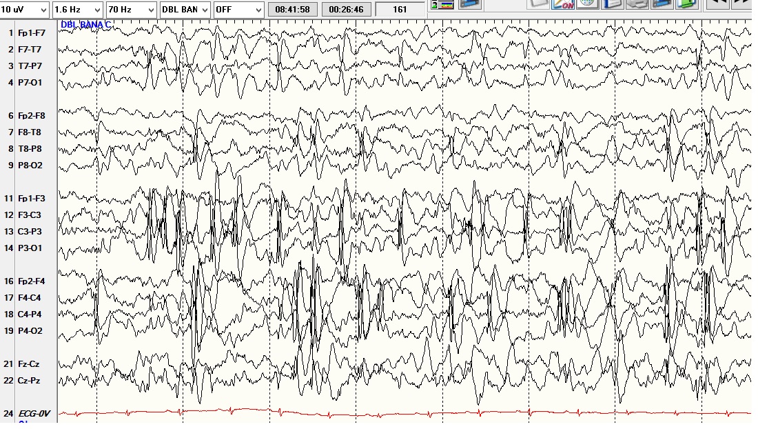 EEG with central temporal spikes
