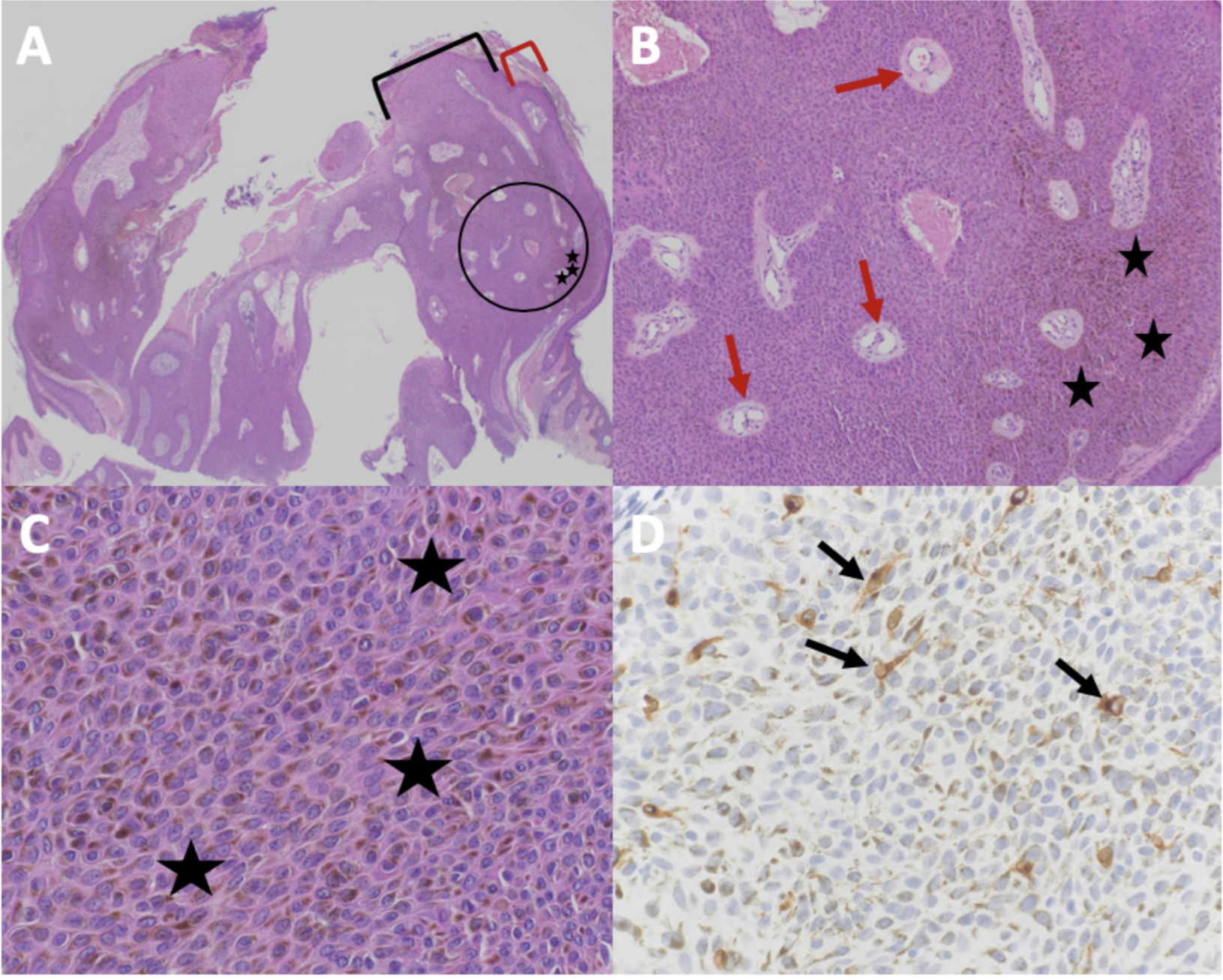Figure 2. Microscopic presentation of melanoacanthoma on the right preauricular area. Low (A) and higher (B and C) magnification of hematoxylin and eosin (H&E) stained sections shows an exophytic nodule with hyperkeratosis (thickening of the stratum corneum as shown between the red bracket) and acanthosis (thickening of the epidermis as shown between the black bracket); the area enclosed in the black circle of image A is shown at higher magnification in image B.  There is hyperpigmentation throughout all layers of the epidermis (black stars).  Tangential sectioning of the tumor shows small areas of dermis, containing epithelial lined vessels and erythrocytes within the epithelium (red arrows).  There is lymphocytic perivascular inflammation in the dermis.  A higher magnification view (D) of MART-1 stained section shows positive staining of dendritic melanocytes throughout all layers of the epidermis (black arrows) (H&E: A, x2; B, x10; C, x40; MART-1 immunoperoxidase; D, x40). 