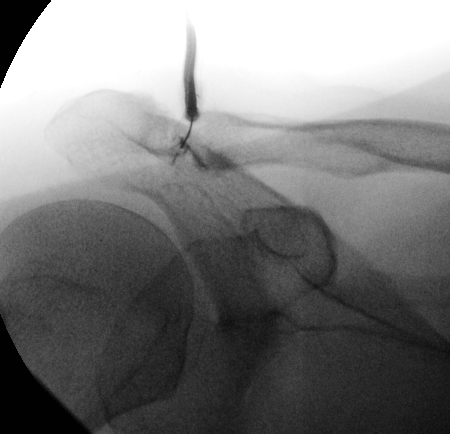Single fluoroscopic image demonstrates targeted injection of the acromioclavicular joint.