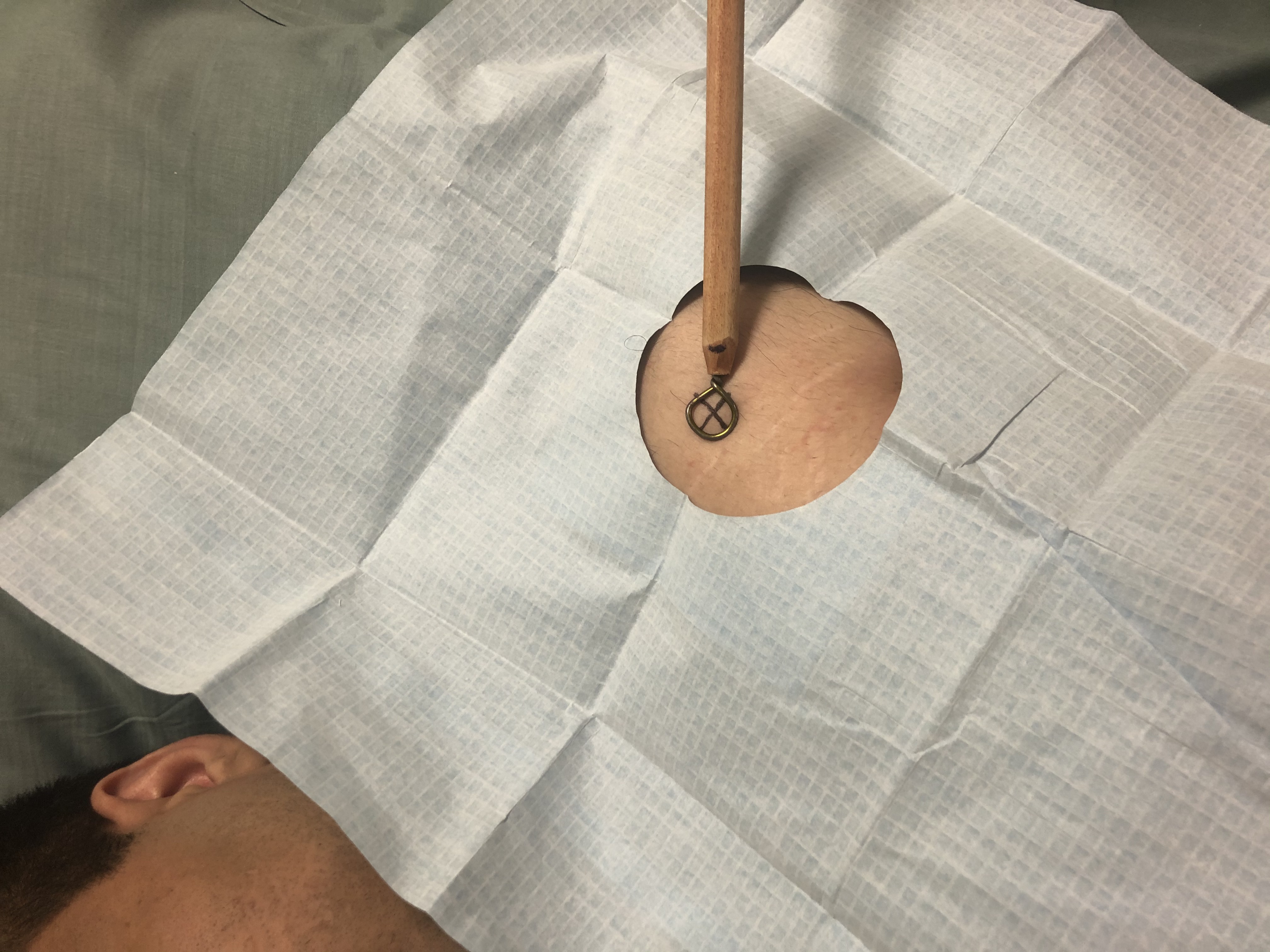 A metallic stick marker is used to assess the location of the skin immediately overlying the glenohumeral joint for a vertical/perpendicular needle approach for injection.