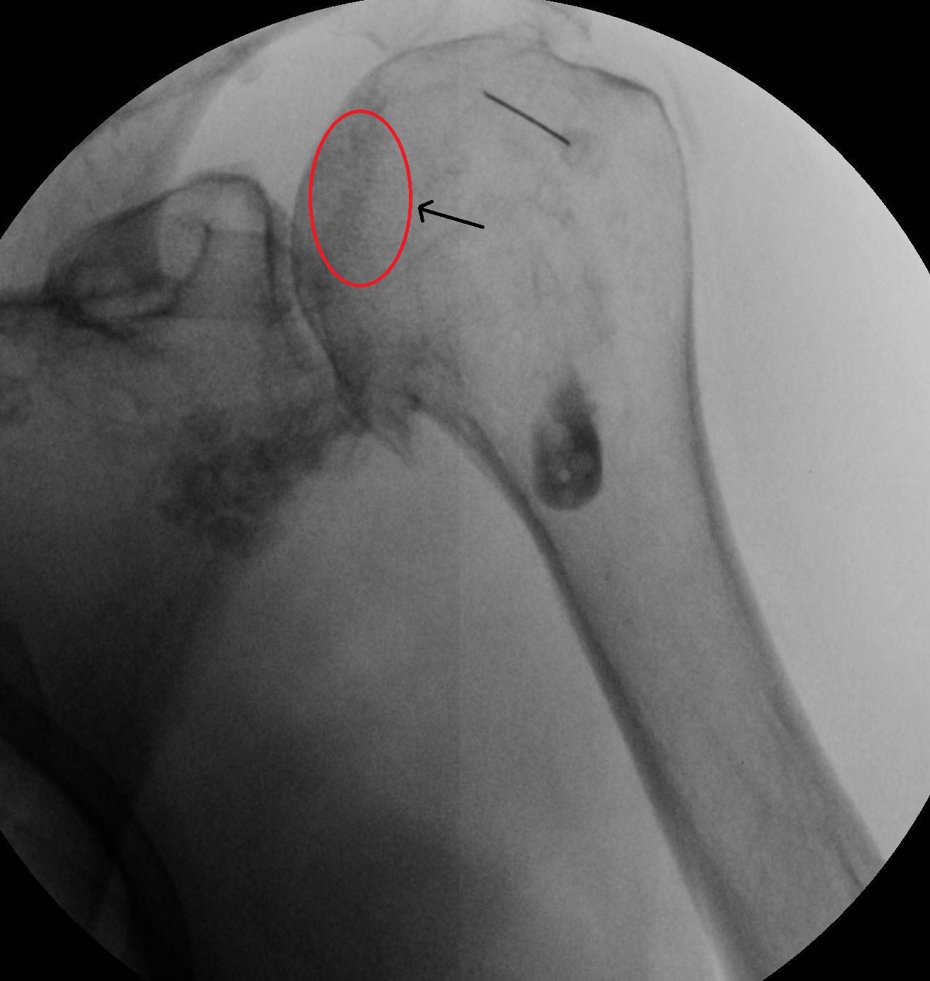 A single fluoroscopic image demonstrates a malpositioned needle within the superior aspect of the humeral head. The correct target at the superomedial humeral head is labeled with a red circle.