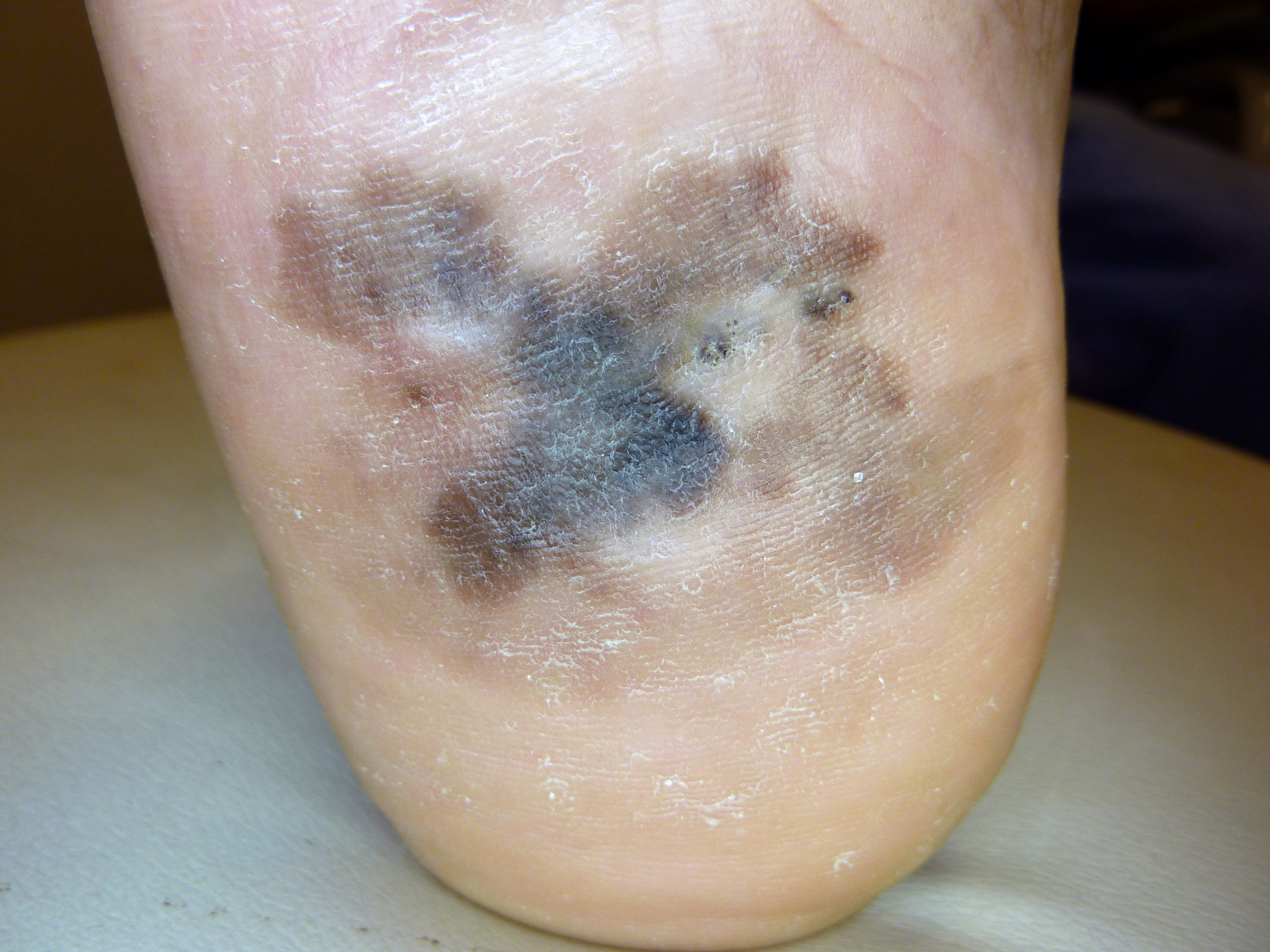 Clinical photo of an acral lentiginous melanoma.  This large lesion has irregular borders and has variable pigmentation from light brown to black. 