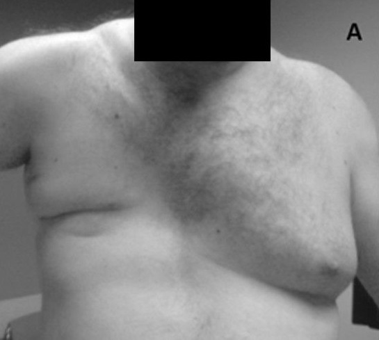 Poland Syndrome with absence of pectoralis major muscle.