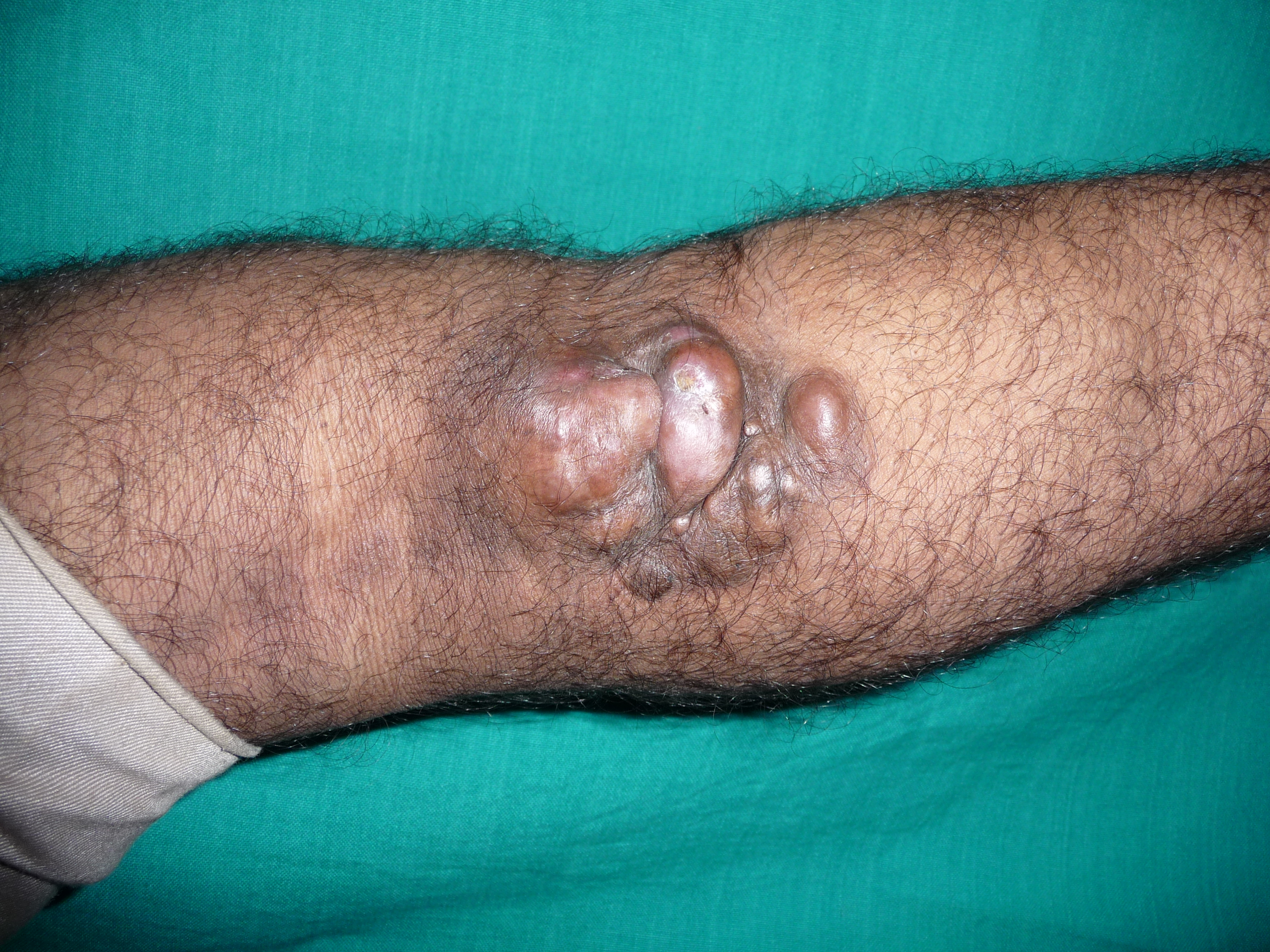 Dermatofibrosarcoma protuberans