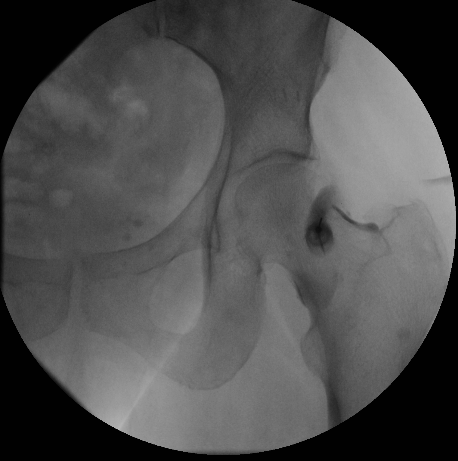 A small amount of iodinated contrast is injected into the femoroacetabular joint to ensure appropriate needle entry into the joint space.