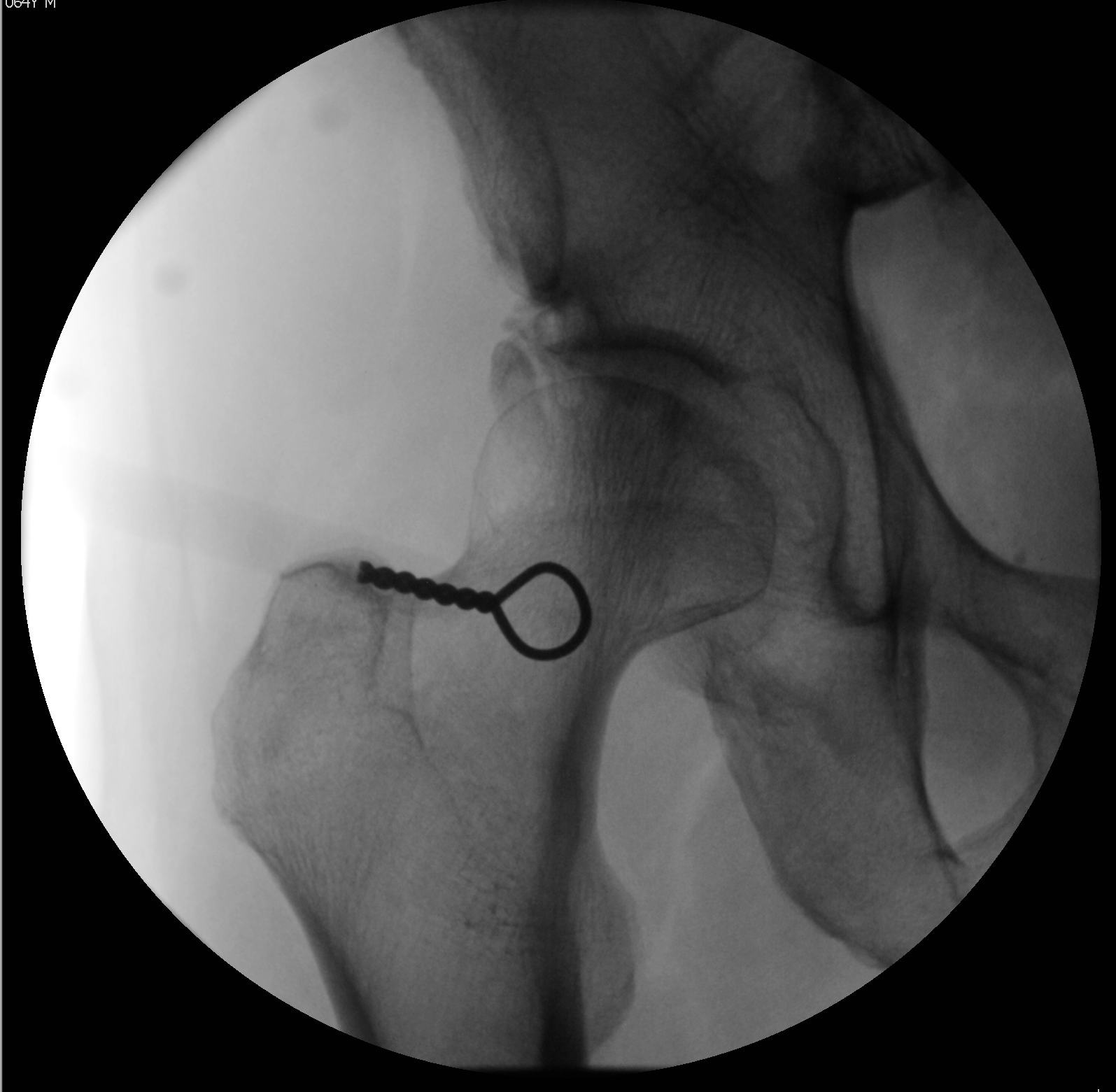 Initial fluoroscopic visualization of the hip joint. The metallic marker denotes the femoral head-neck junction as the target site for injection