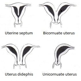 Types of Bicornuate Uterus malformation.  A uterine malformation is a type of female genital malformation resulting from an abnormal development of the Müllerian duct(s) during embryogenesis. The prevalence of uterine malformation is estimated to be 6-7% in the human female population. They may cause premature birth. Didelphis and bicornuate uterus are the normal anatomy in some mammals, just not in humans.