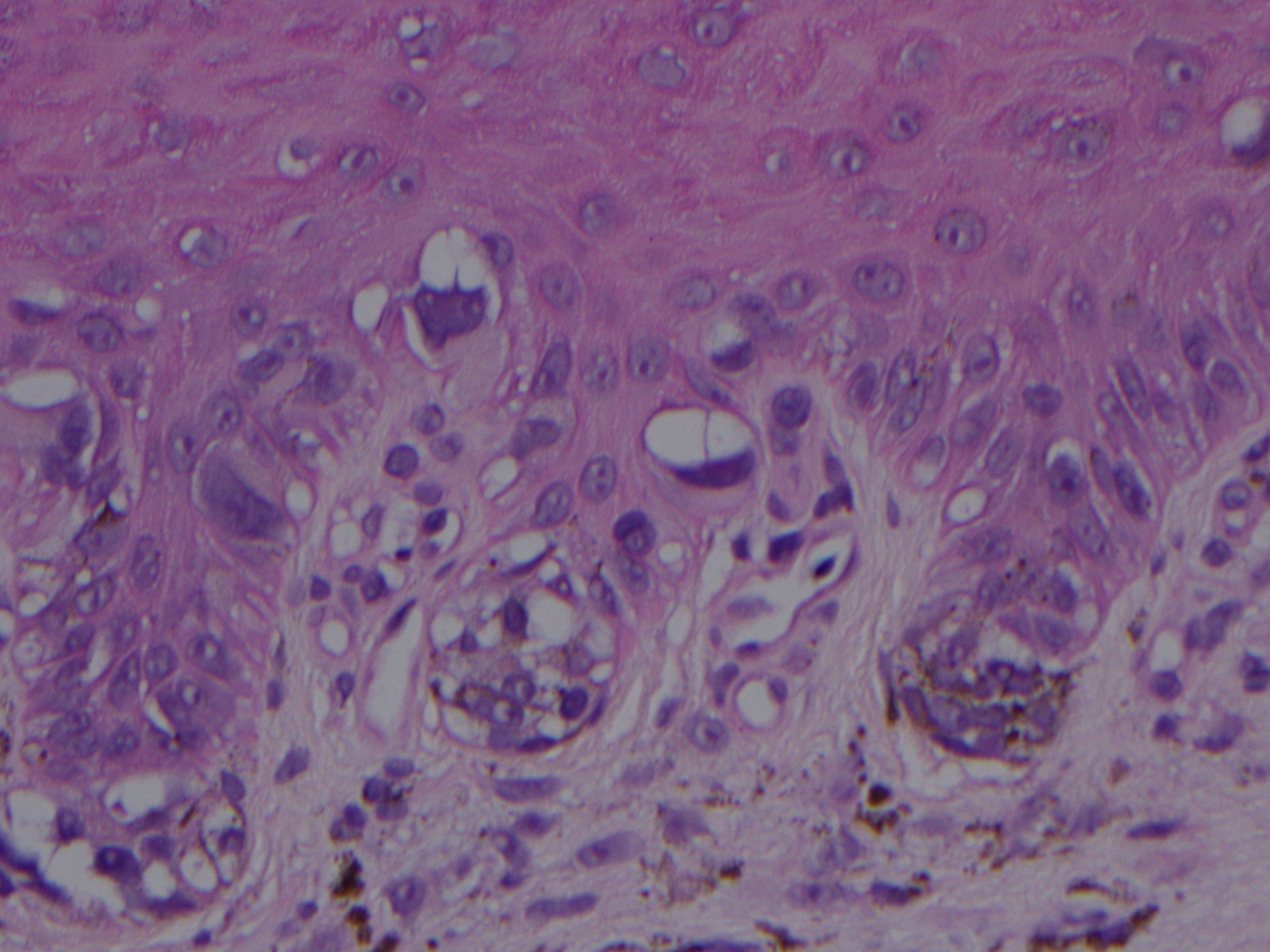 This Hematoxylin and Eosin stained section of an acral lentiginous melanoma in-situ shows large atypical melanocytes with pleomorphic and hyperchromatic nuclei arranged along the dermal-epidermal junction.