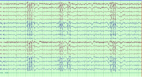 Fig 1
EEG showing 3-3.5 Hz Generalized Spike and wave and polyspike and wave discharges
