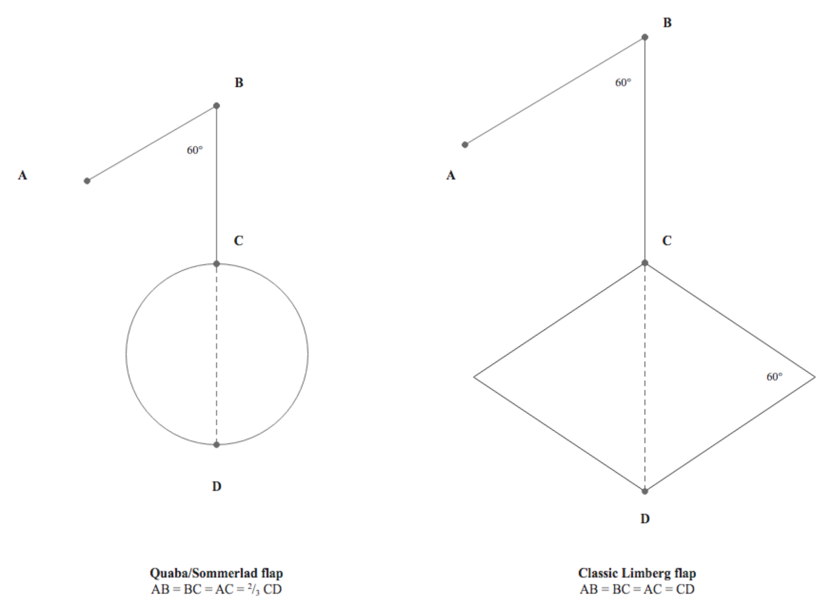 Figure 4: Comparison between Quaba/ Sommerlad flap modified design and classic Limberg design. For the modified design: the defect may be round in shape and reconstructed with a rhombic flap smaller than the defect.