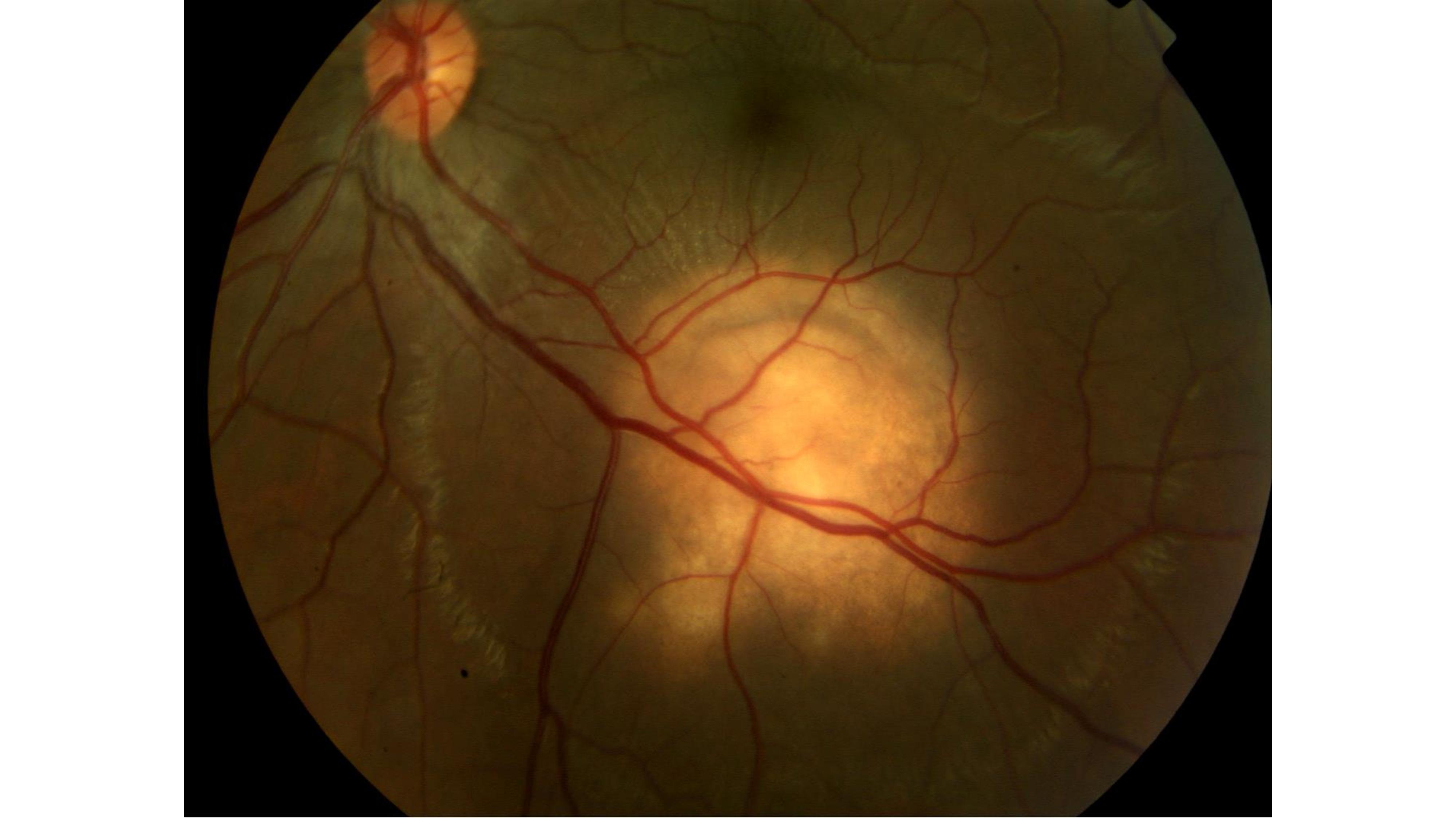 Large choroidal granuloma with subretinal fluid reaching the macula in a patient with TB choroiditis.