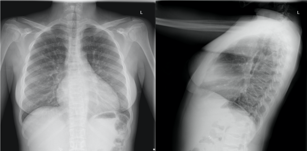 Normal chest radiograph in the PA and Lateral projections.