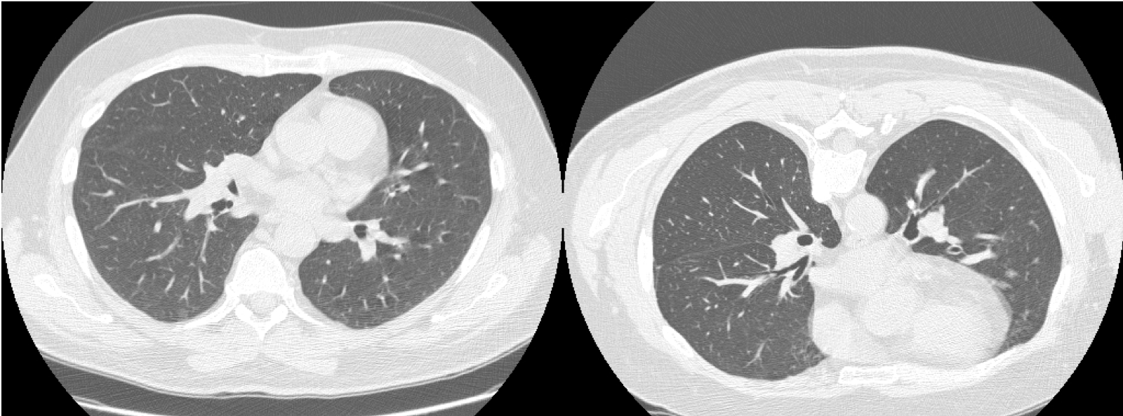 High resolution computed tomography of the lungs in the supine and prone positions demonstrating normal lung parenchyma.