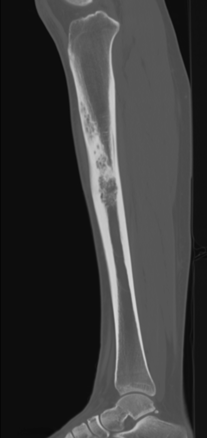 Anterior tibial sclerotic lesion representing a biopsy proven adamantinoma.