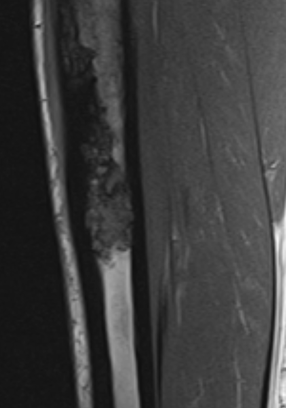 T1 low signal intramedullary lesion within the anterior tibia representative of a biopsy proven adamantinoma.