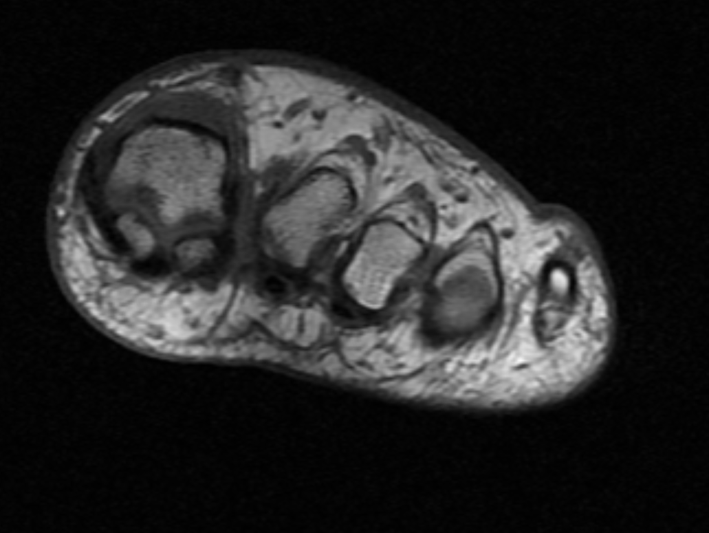Coronal T1 sequence MRI demonstrates a Morton's neuroma between the first and second metatarsals.