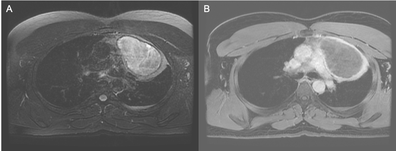 Axial T2 fat-sat image (A) showing an anterior mediastinal cystic mass. T1 post-contrast axial image (B) demonstrates rim enhancement of the lesion.
