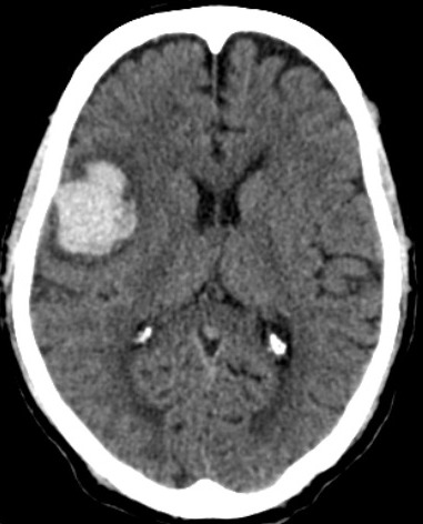 Fig.1. CT scan of lobar hemorrhage