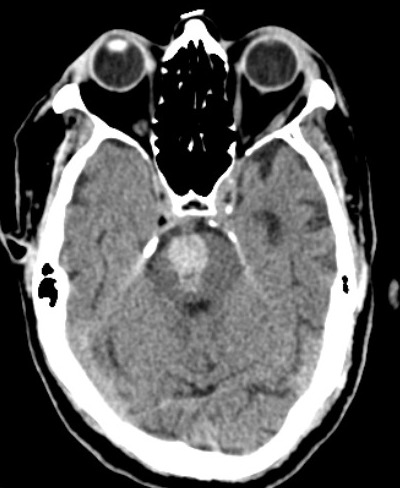 Fig.2. CT scan of pontine hemorrhage.