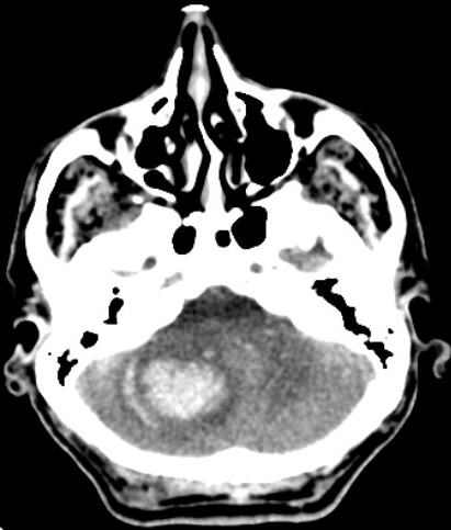 Fig.3. CT scan of cerebellar hemorrhage.