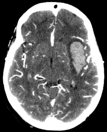 Fig.4. CT Angiogram of a patient with ICH