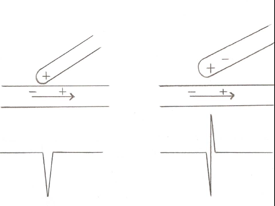 Figure 1. A unipolar EMG recording (left) and a bipolar EMG recording (right)
