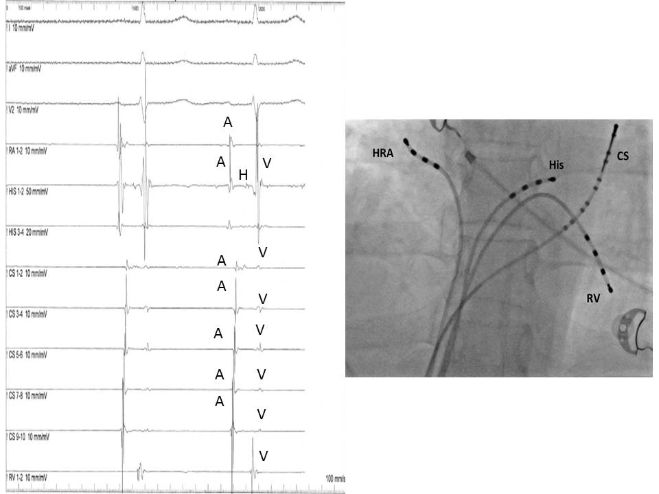 Figure 2. A typical  electrophysiologic recording (left) with a fluoroscopic image of the recording catheters (right)