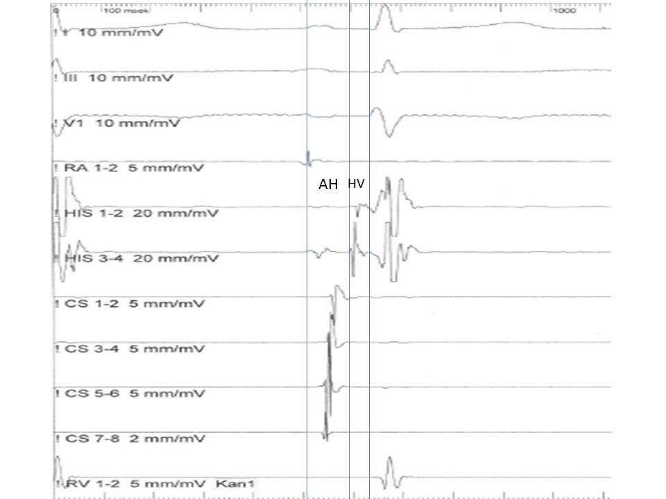 Figure 3. AH and HV intervals in the His bundle recording
