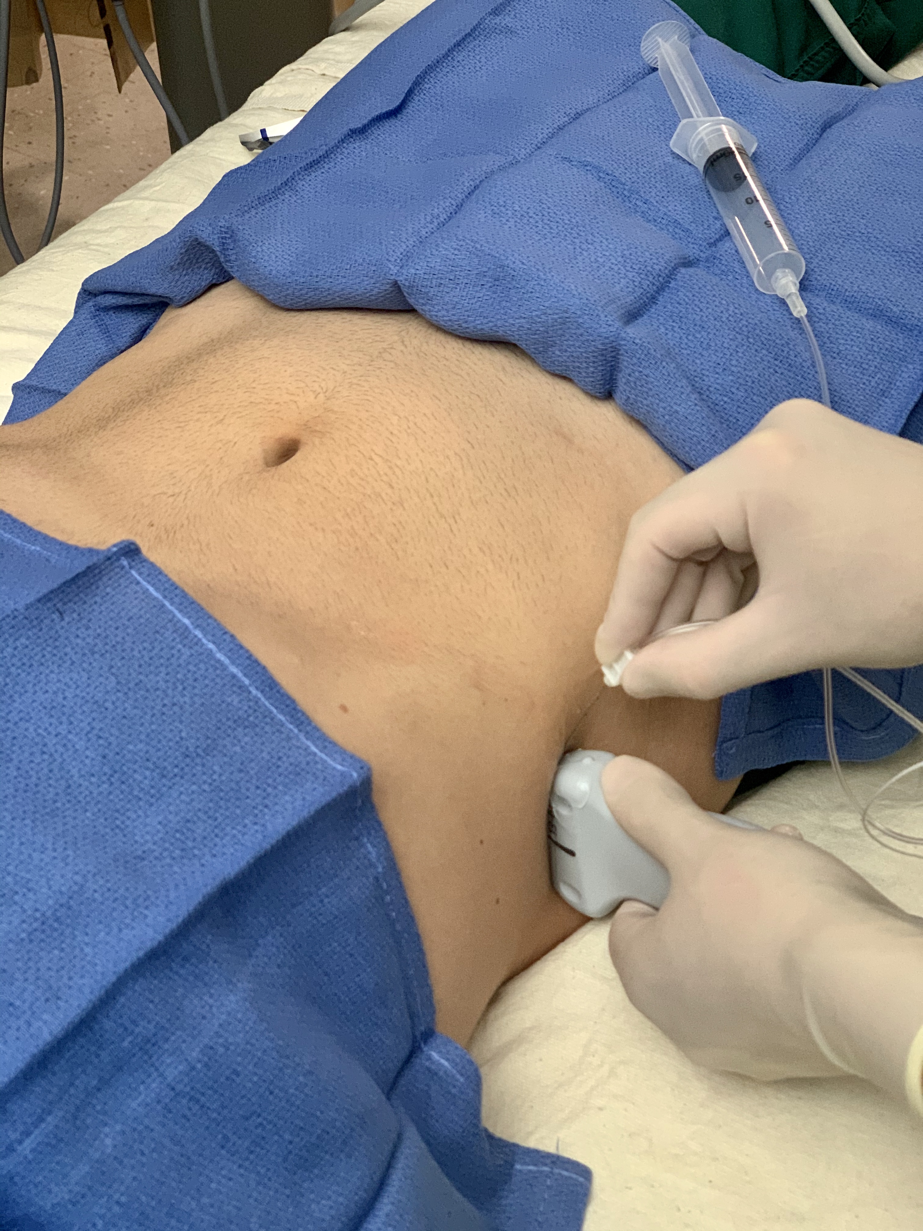 <p>Lateral TAP Block Approach. Probe and needle position for lateral transabdominal plane (TAP) block approach.</p>