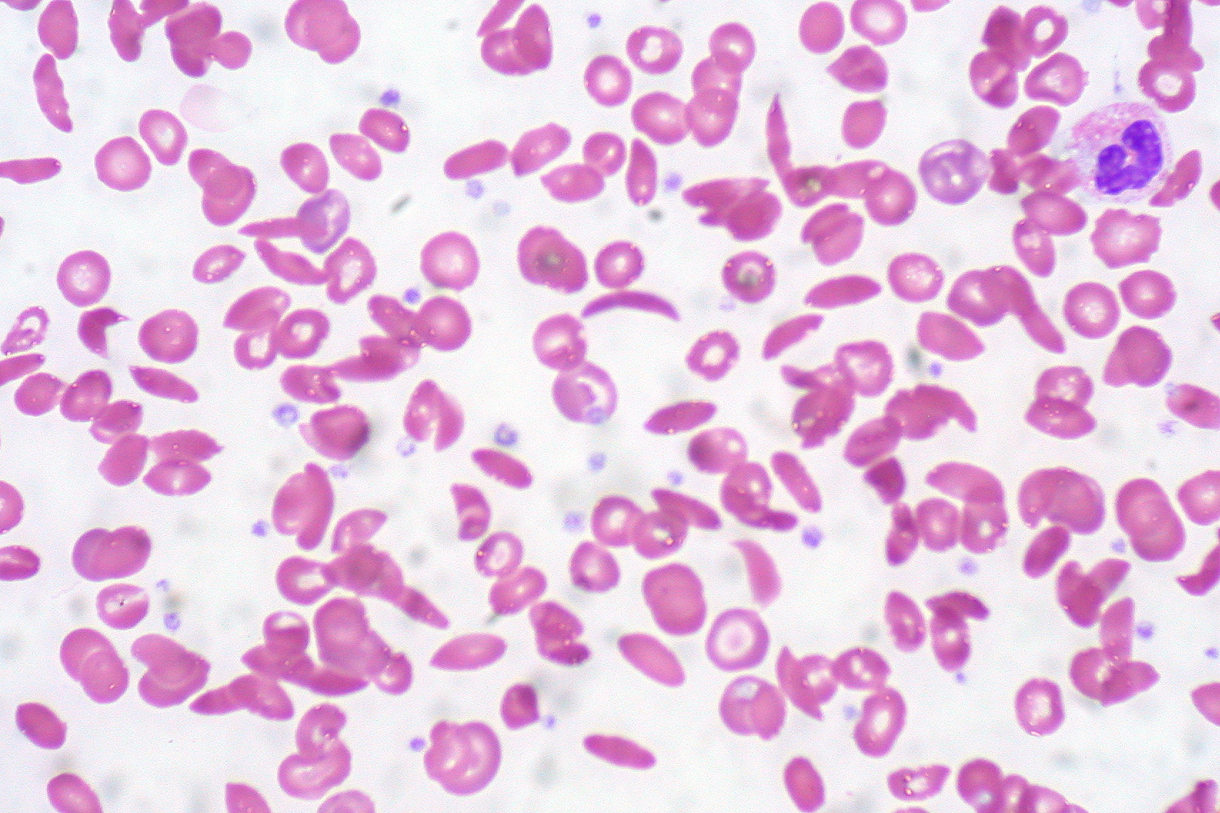 Sickle Cell Anemia, Hemoglobin C