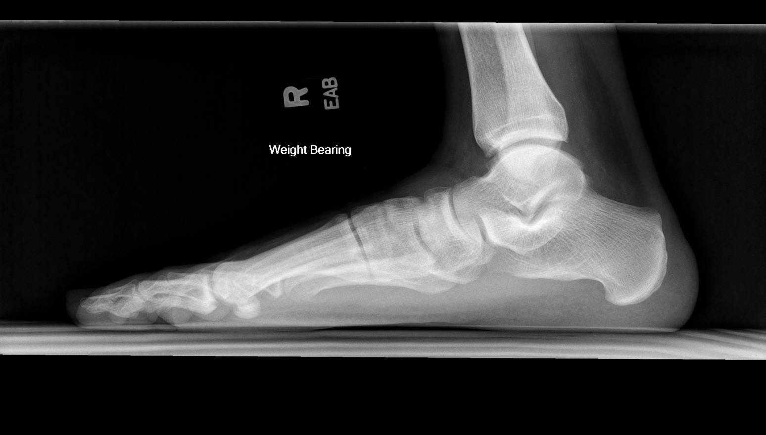 Single lateral radiograph demonstrating pes planus. No other abnormalities are visualized.