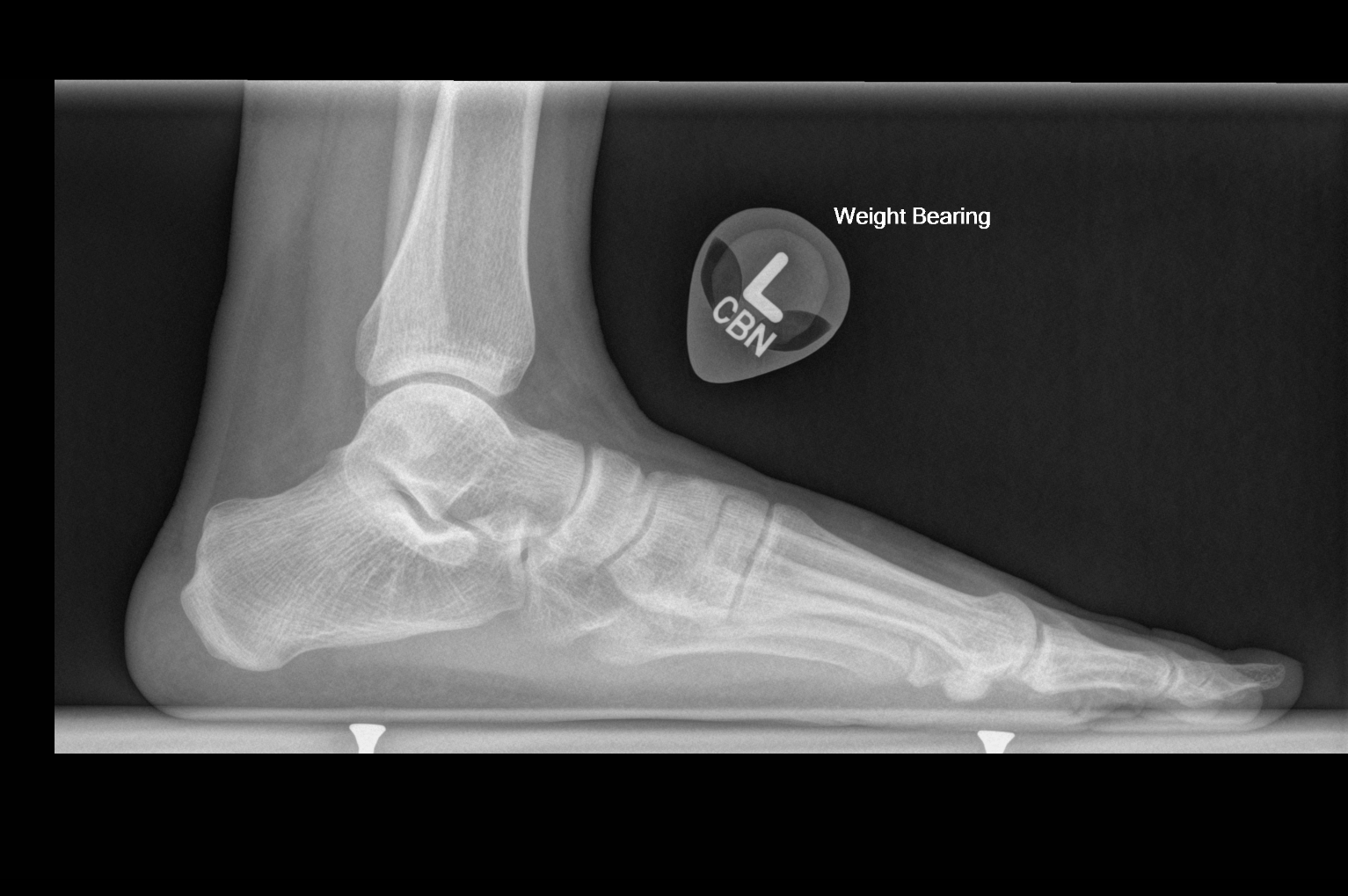 Single lateral radiograph of the left foot demonstrates pes planus as evidenced by a decreased calcaneal inclination angle.