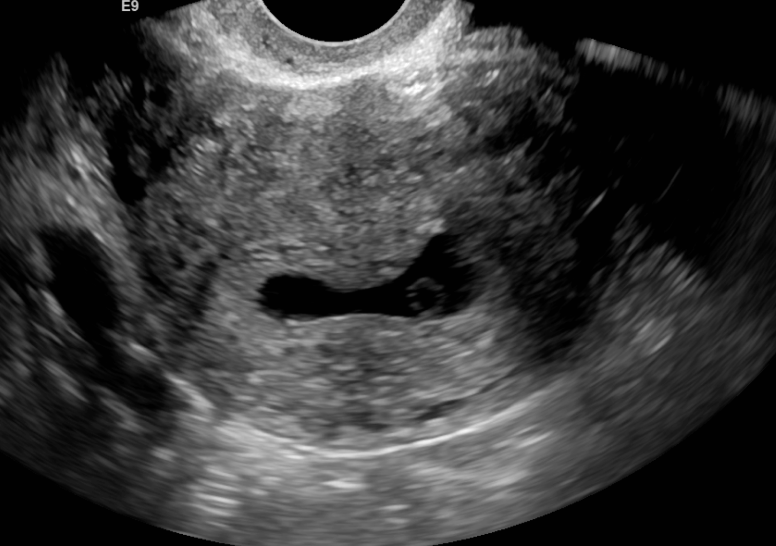 Single sonographic image demonstrating a gestational sac with a yolk sac. No fetal pole is seen. This is representative of a blighted ovum.