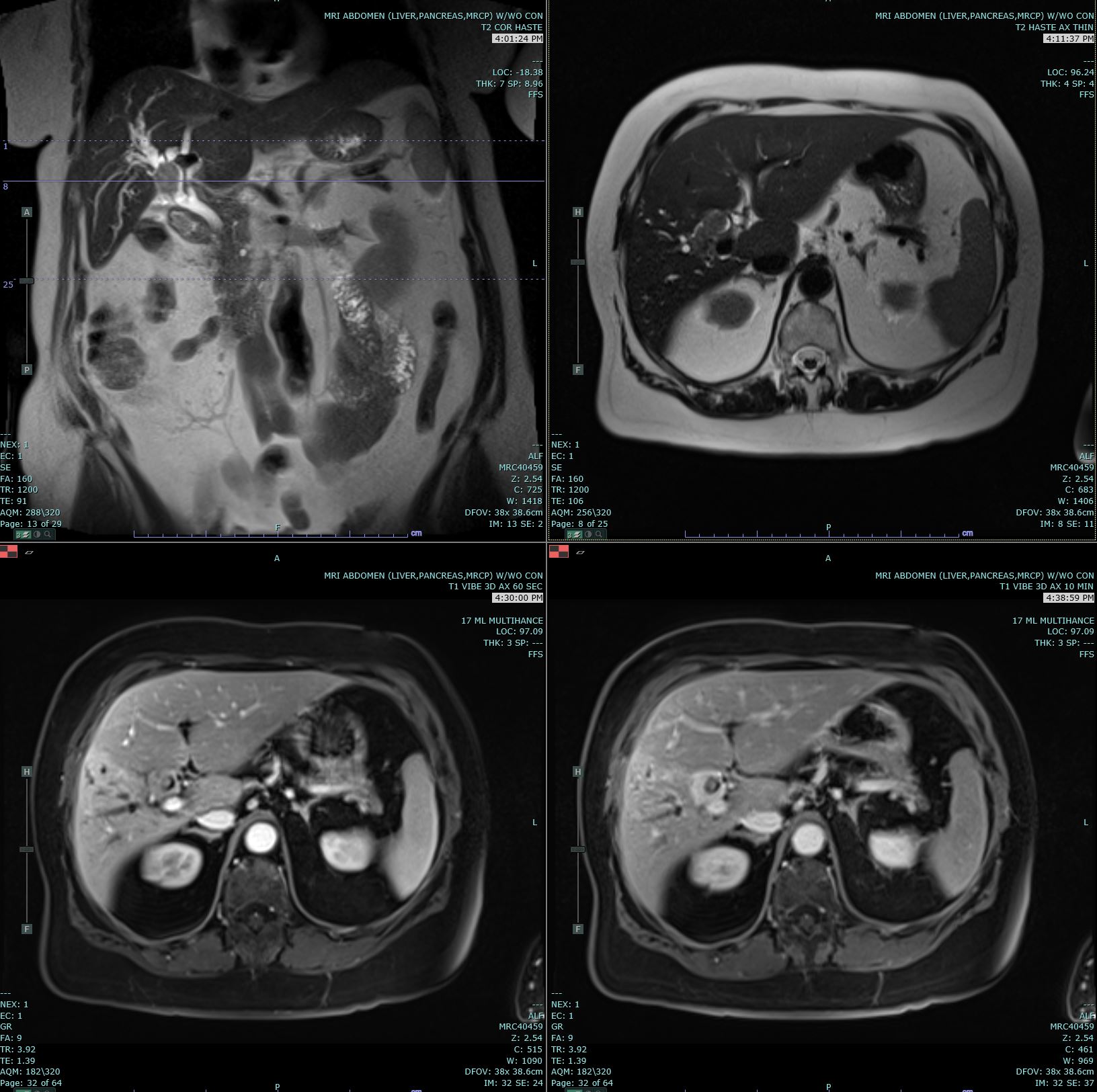 Coronal T2 Haste, Axial T2 Haste and 60 and 10 minute post contrast T1 Vibe images are submitted. There is a delayed enhancing hilar mass biopsy proven to be cholangiocarcinoma. This mass has increased T2 signal in comparison to the background liver parenchyma. 