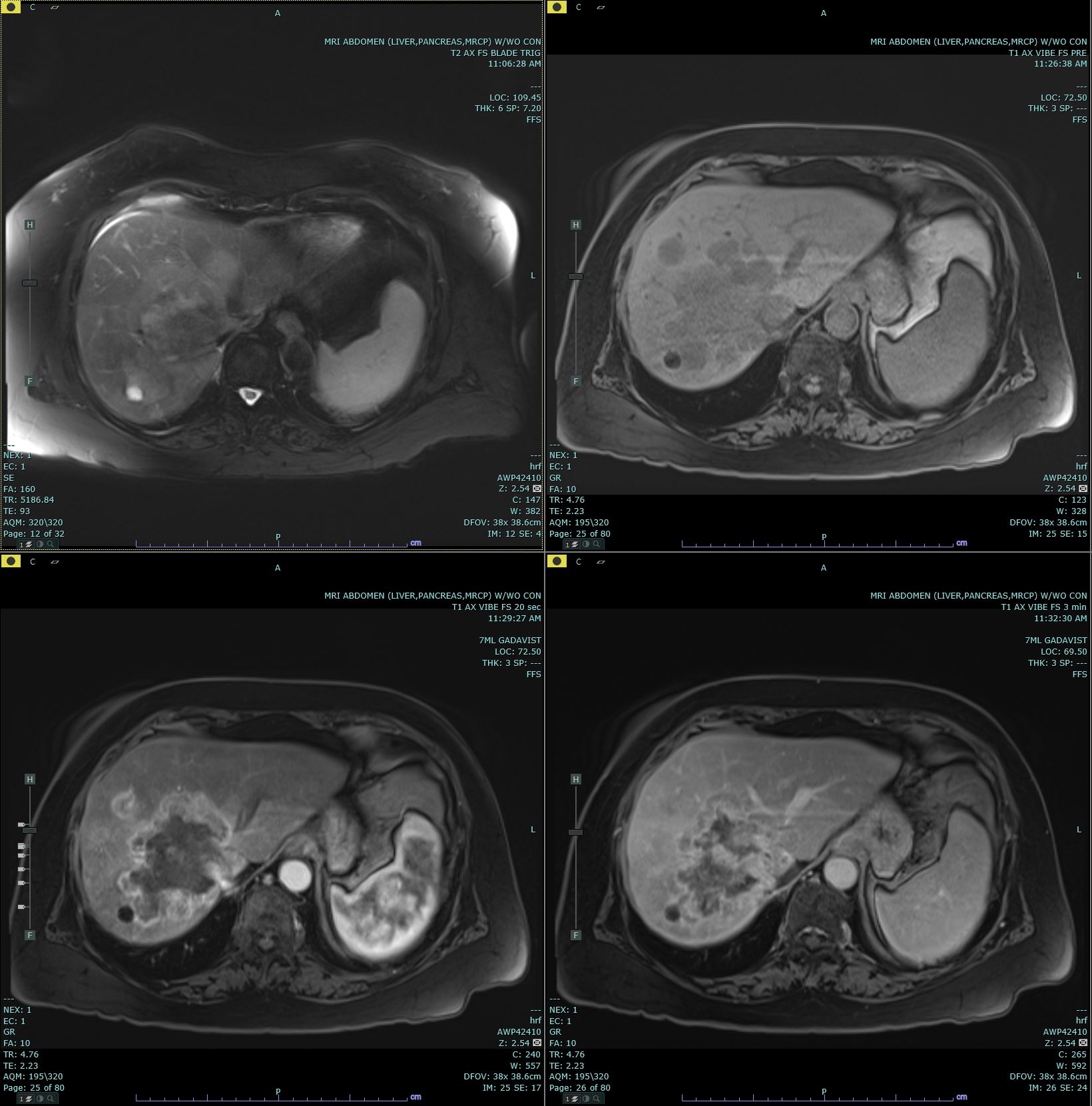 Axial T2 Haste, Pre T1 Vibe, and 20 second and 3 minute post contrast T1 Vibe images are submitted. There is a delayed enhancing mass in the right hepatic lobe which is biopsy proven to be cholangiocarcinoma. This mass has increased T2 signal in comparison to the background liver parenchyma with decreased T1 signal also identified. 