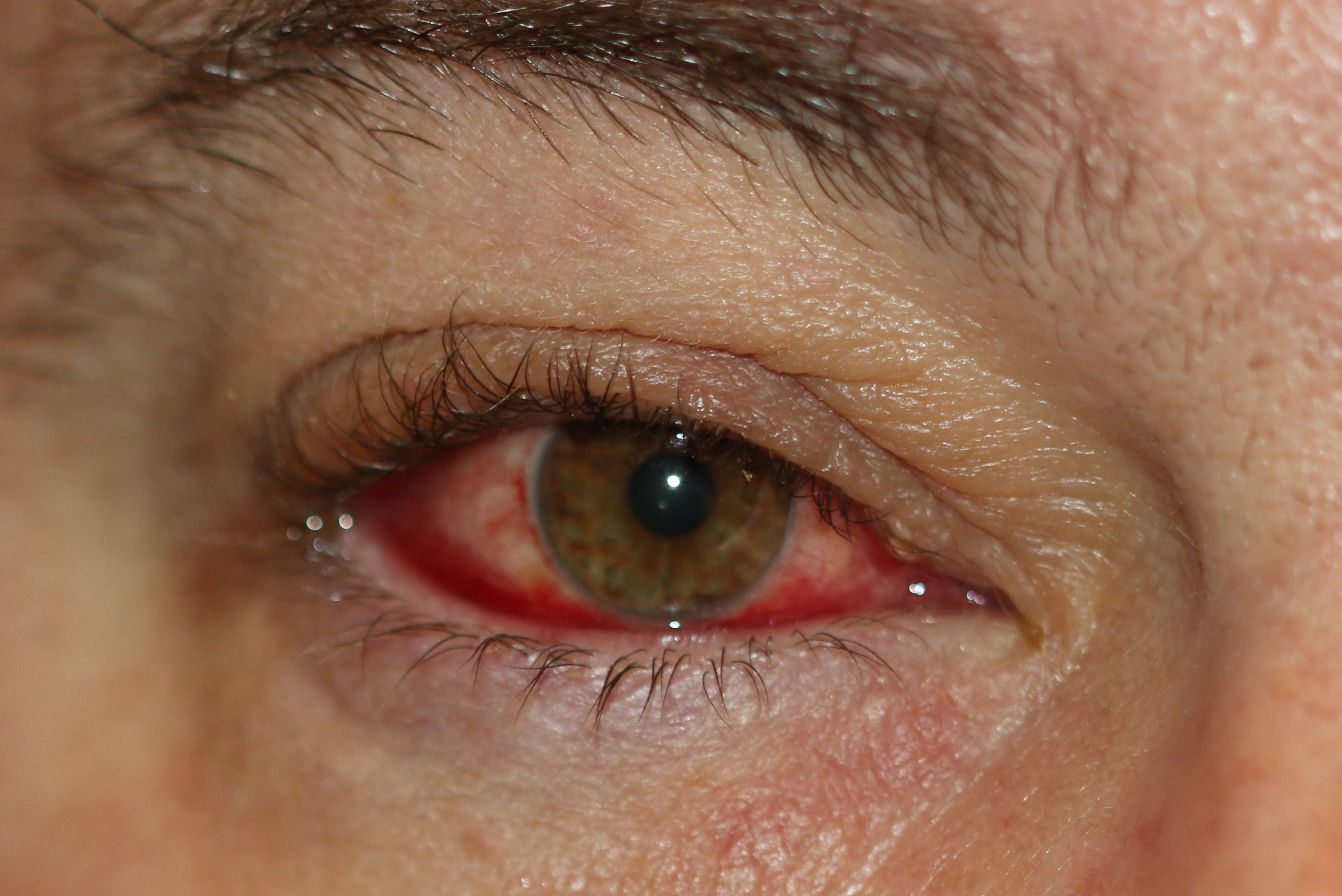 Blepharoconjunctivitis with inflammation of the eyelid margin and conjunctiva