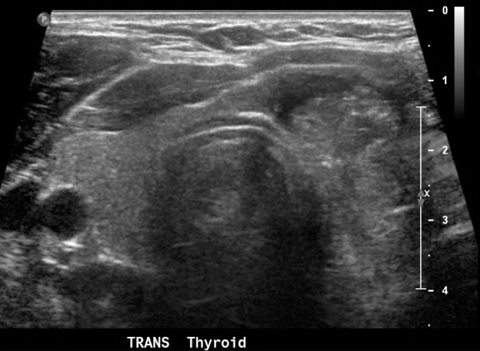 Left thyroid nodule with microcalcifications