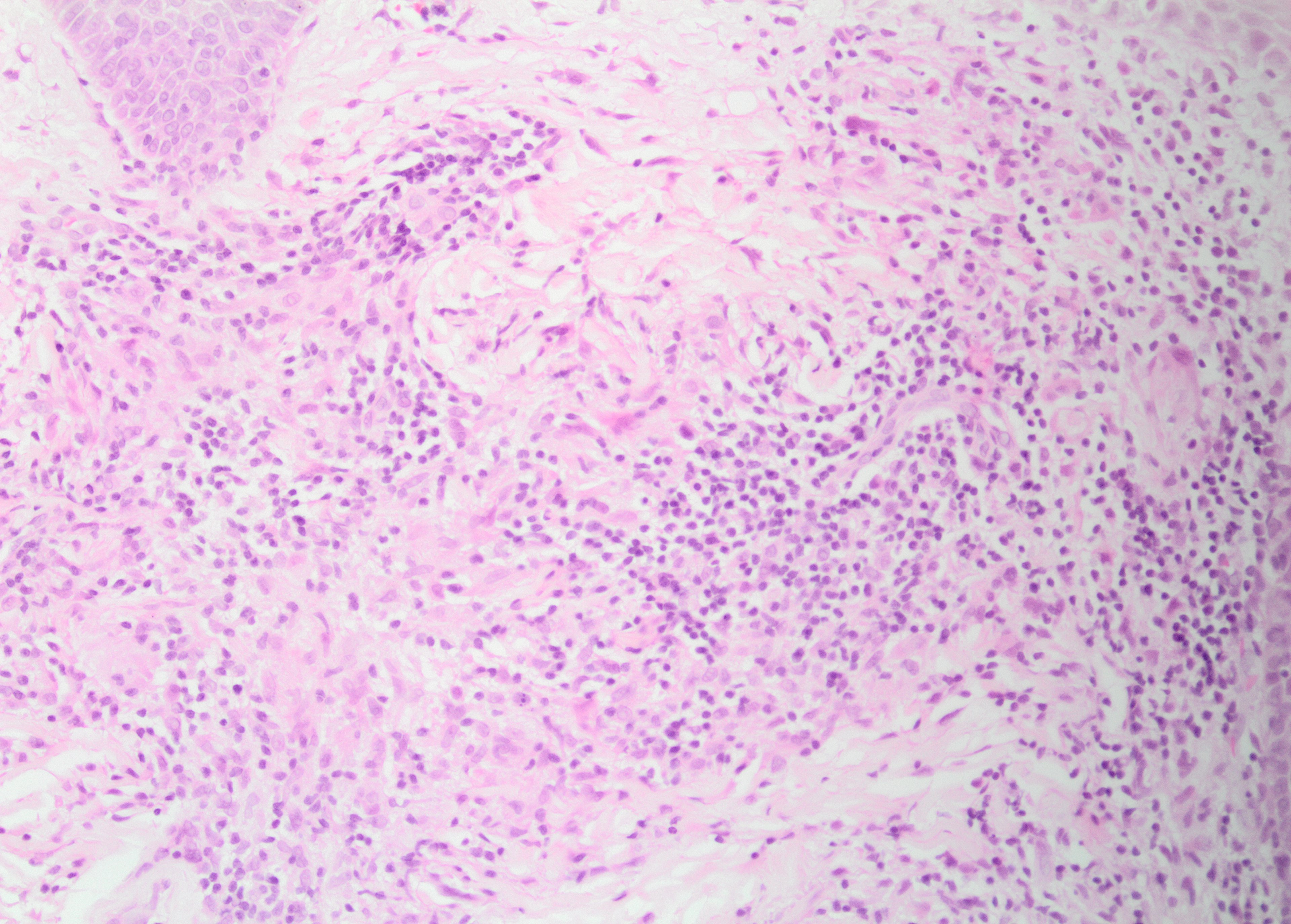 <p>Granulomatous Inflammation Without Caseation