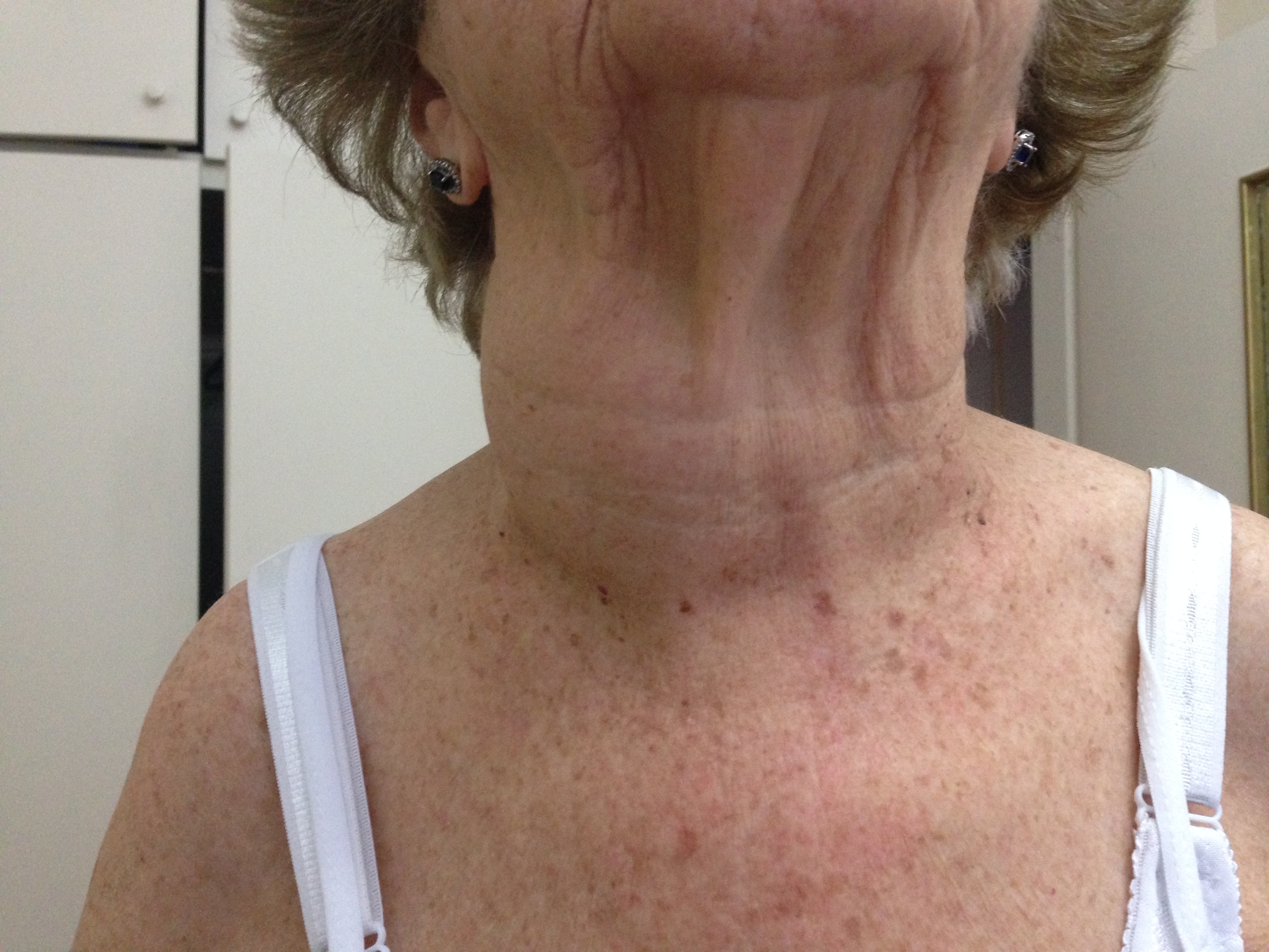 Right thyroid nodule, multinodular goiter