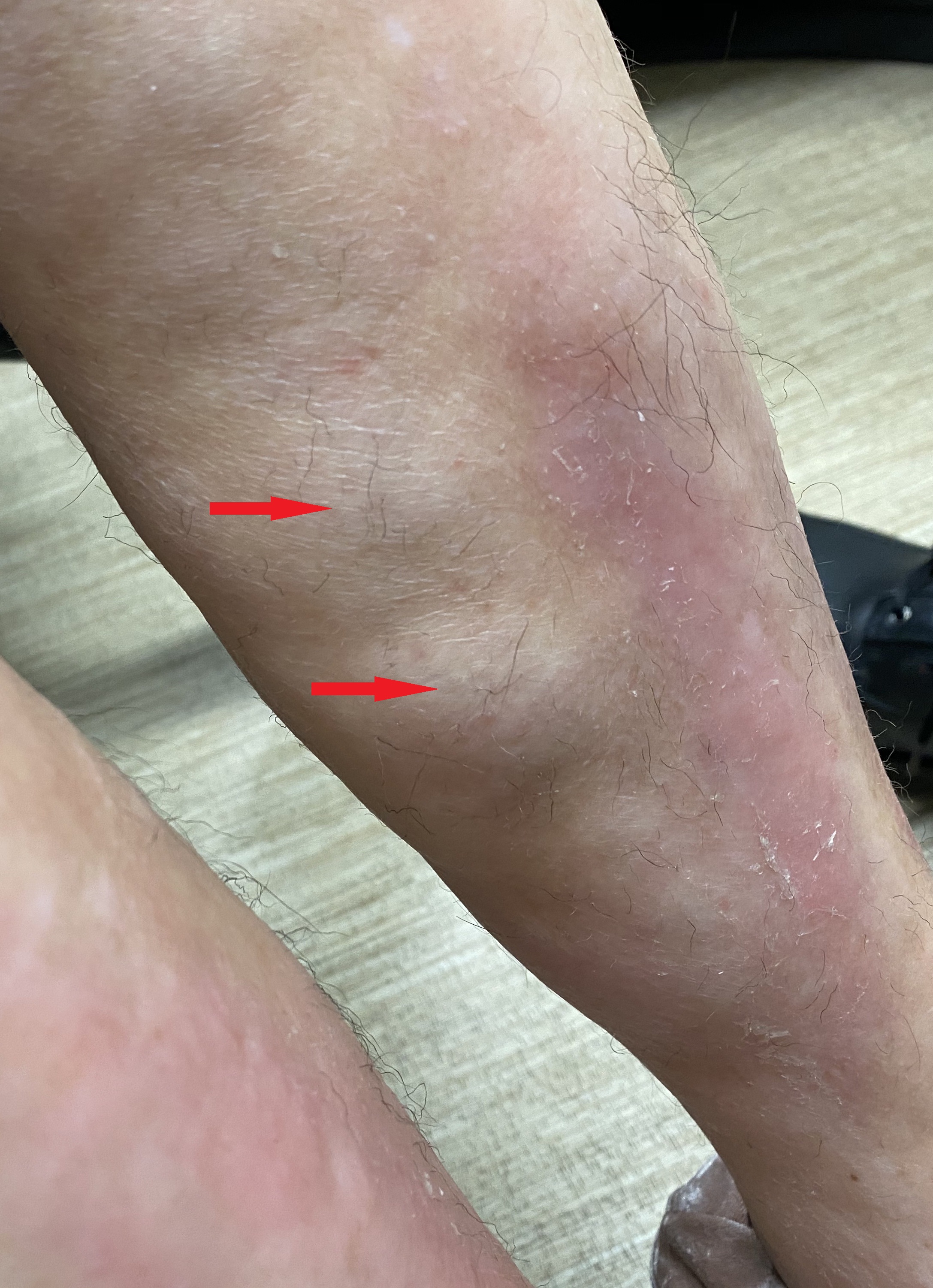 Extensive involvement of the skin of the lower extremities showing nodular areas of hypopigmentation, alopecia, and sclerosis (red arrows).